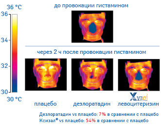 Зримое» превосходство Ксизала®. Термография лица после провокации гистамином на фоне применения плацебо, дезлоратадина и левоцетиризина