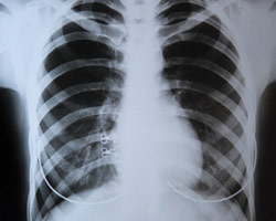 Новая надежда в лечении туберкулеза легких