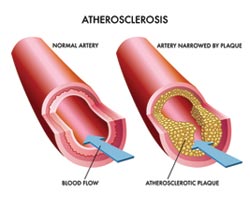 Ученые победили атеросклероз?