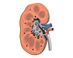 Чем опасны камни в почках?
