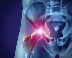 Чем опасен остеопороз для мужчин?