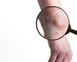 Пробиотик поможет в борьбе с проблемной кожей?