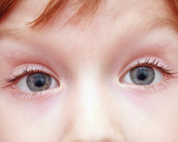 Синдром «ленивого глаза»: необходимость ранней диагностики
